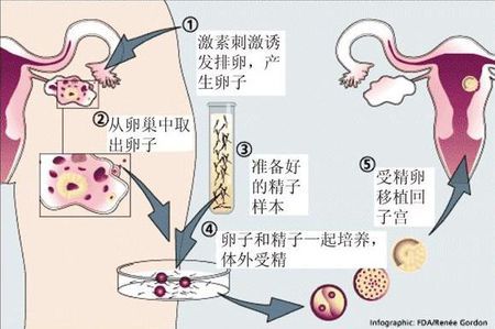 专业拉拉代怀助孕费用多少